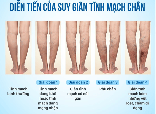 Người bị suy giãn tĩnh mạch có nên đi bộ?