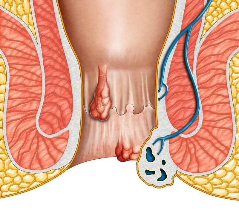 4 cách chữa trị bệnh trĩ an toàn và hiệu quả