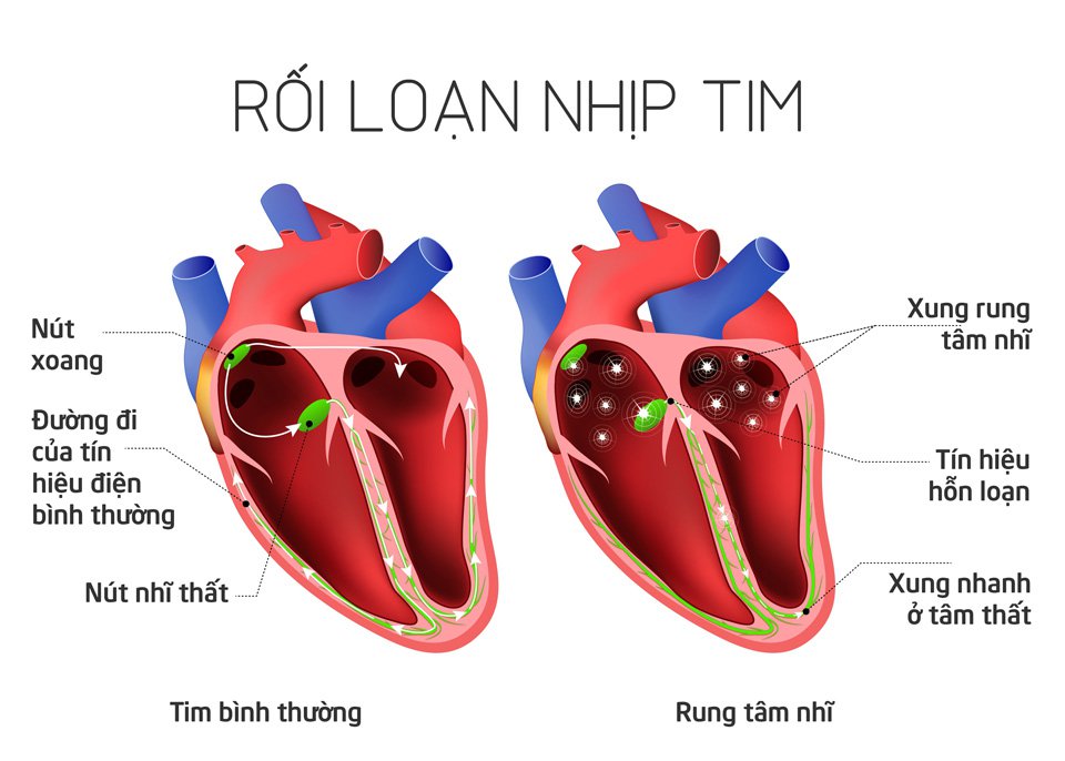 Rối loạn nhịp tim là gì? Tất tần tật thông tin bạn cần biết về rối loạn nhịp tim