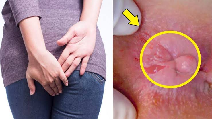 Tổng hợp các cách chữa búi trĩ tại nhà đơn giản và hiệu quả nhất