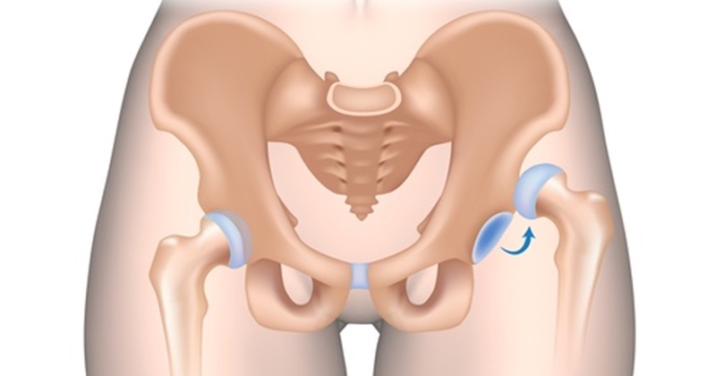 Cách chữa đau khớp háng hiệu quả có thể bạn chưa biết