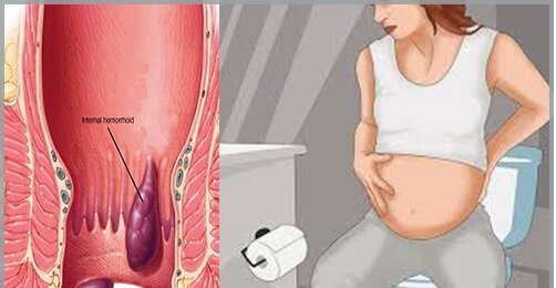5 cách chữa bệnh trĩ cho bà bầu tại nhà hiệu quả 