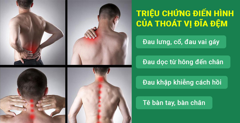Triệu chứng thoát vị đĩa đệm: Nhận diện và điều trị