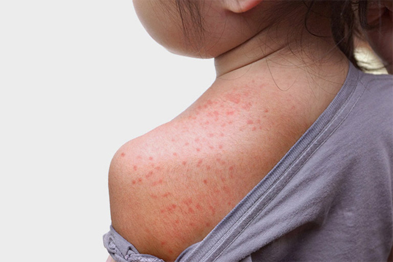 Triệu chứng men gan cao: Những điều cần biết về tình trạng gan