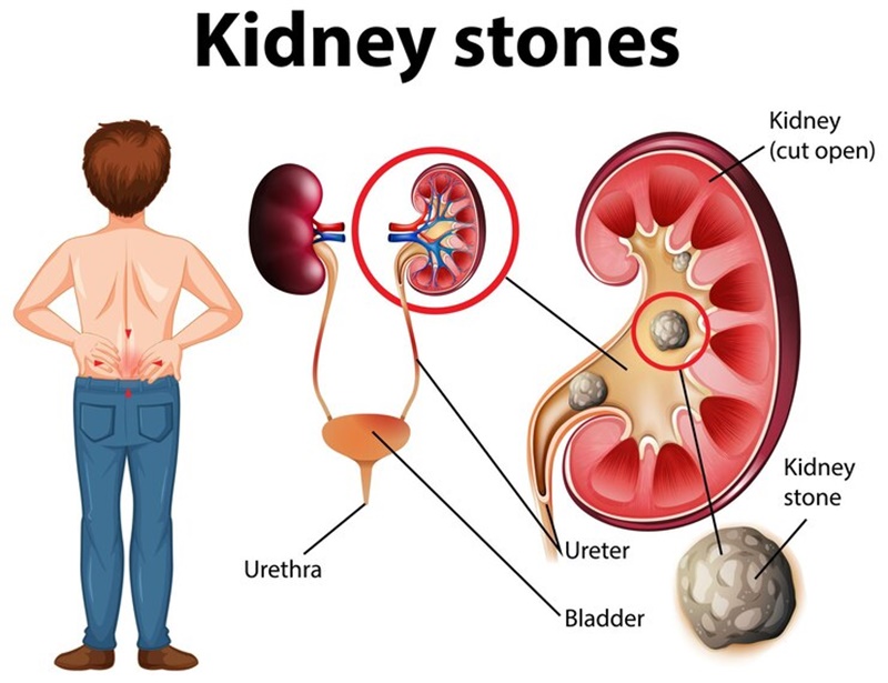 Mổ sỏi thận có nguy hiểm không?