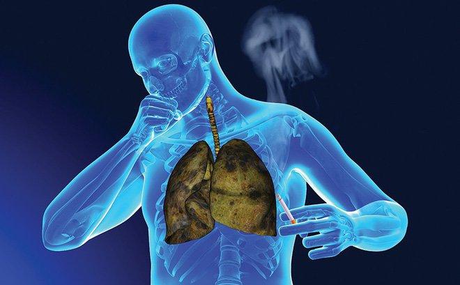 Viêm phổi cấp là gì? Nguyên nhân, triệu chứng và phương pháp điều trị hiệu quả