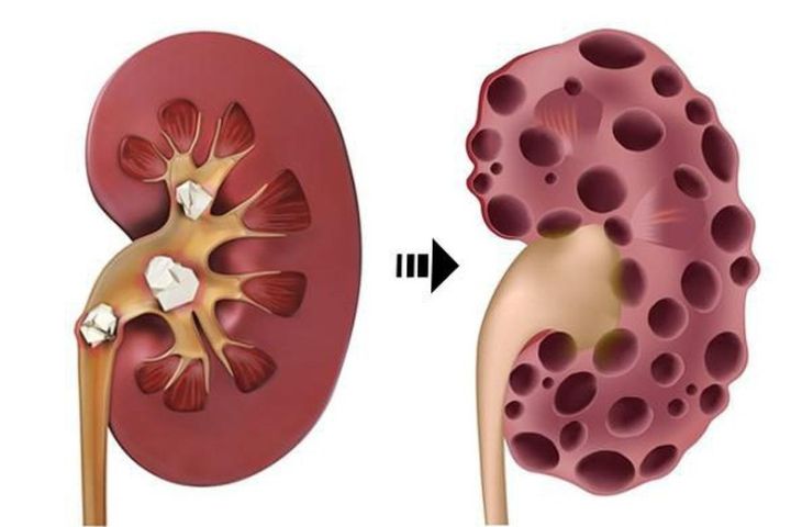 Làm gì để phòng ngừa sỏi thận tái phát?