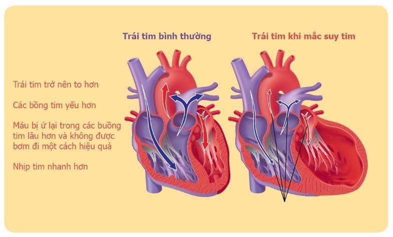 Vì sao huyết áp khác nhau ở từng môi trường?