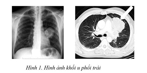 Bác sĩ tư vấn mùa cúm nên ăn gì, uống gì?